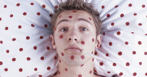 young-man-with-red-spots-on-face-and-body-taking-temperature--portrait-200263951-002-5955608a3df78cdc290e2ec9